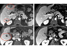 Combination immunotherapy shrank a variety of metastatic solid cancers